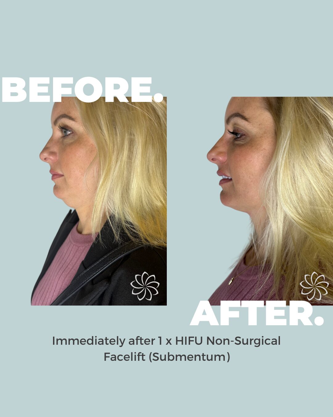 HIFU Lower Face (Cheeks, Neck, & Submentum) - Single Treatment - Image 4