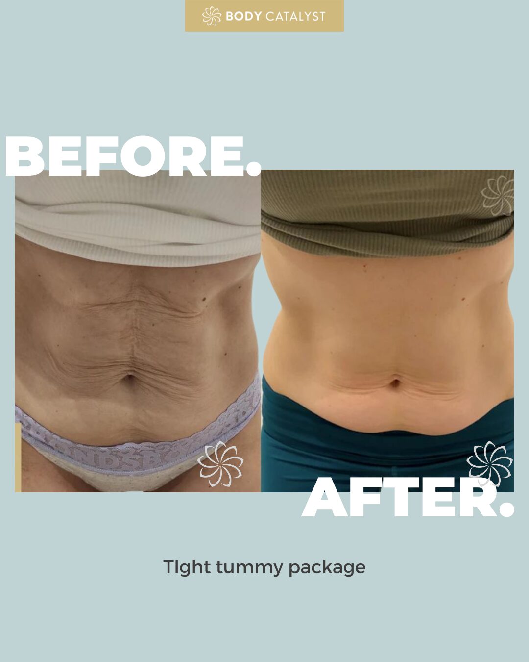Tight Tummy Package - Image 4