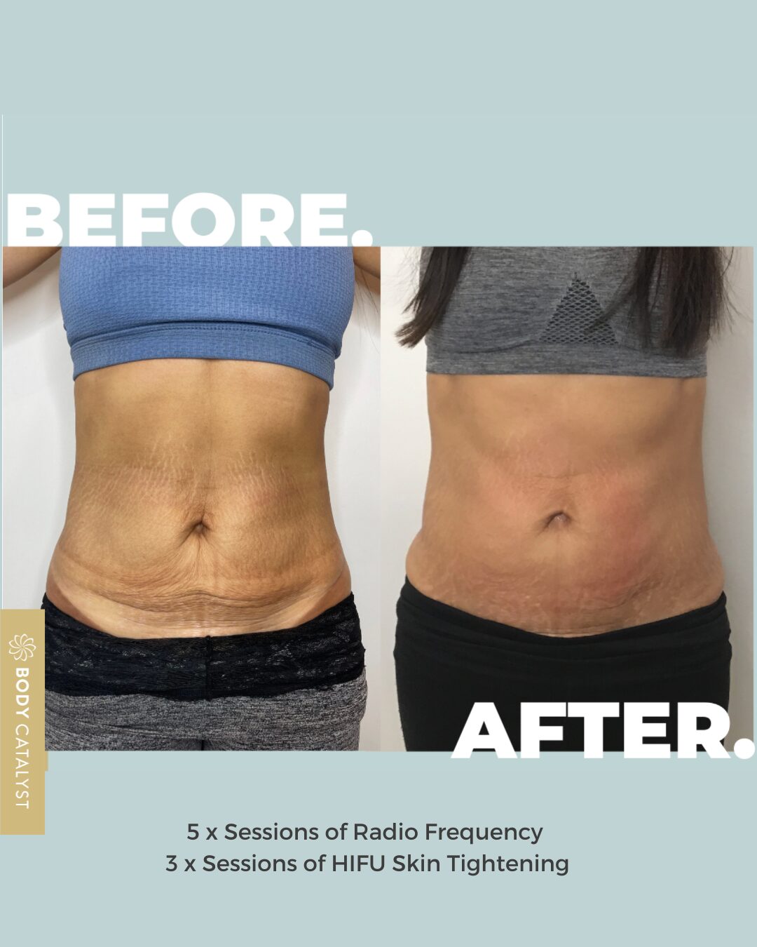 Tight Tummy Package - Image 2