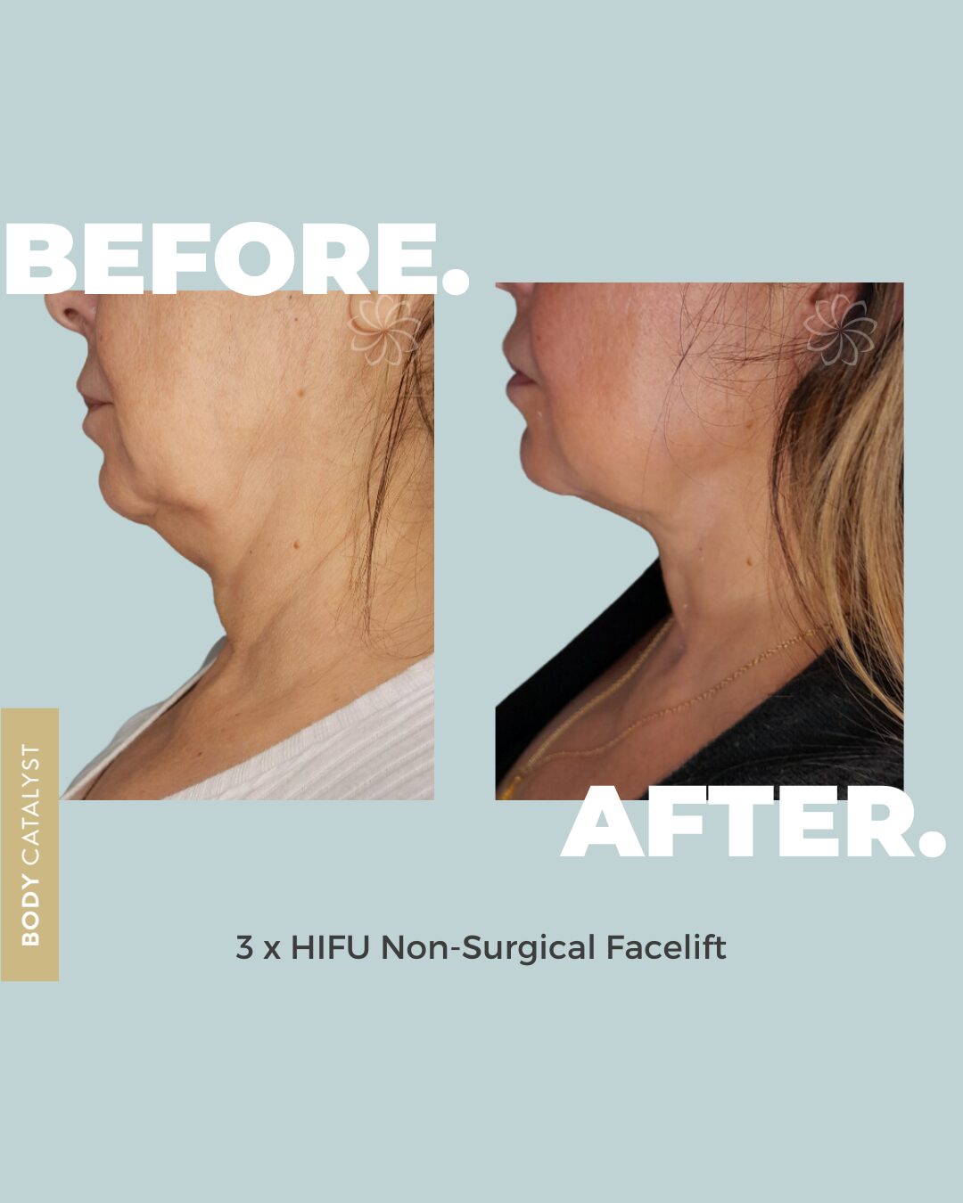 HIFU Lower Face (Cheeks, Neck, & Submentum) - Single Treatment - Image 2