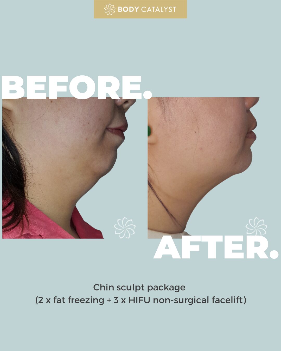 HIFU Lower Face (Cheeks, Neck, & Submentum) - Single Treatment - Image 3