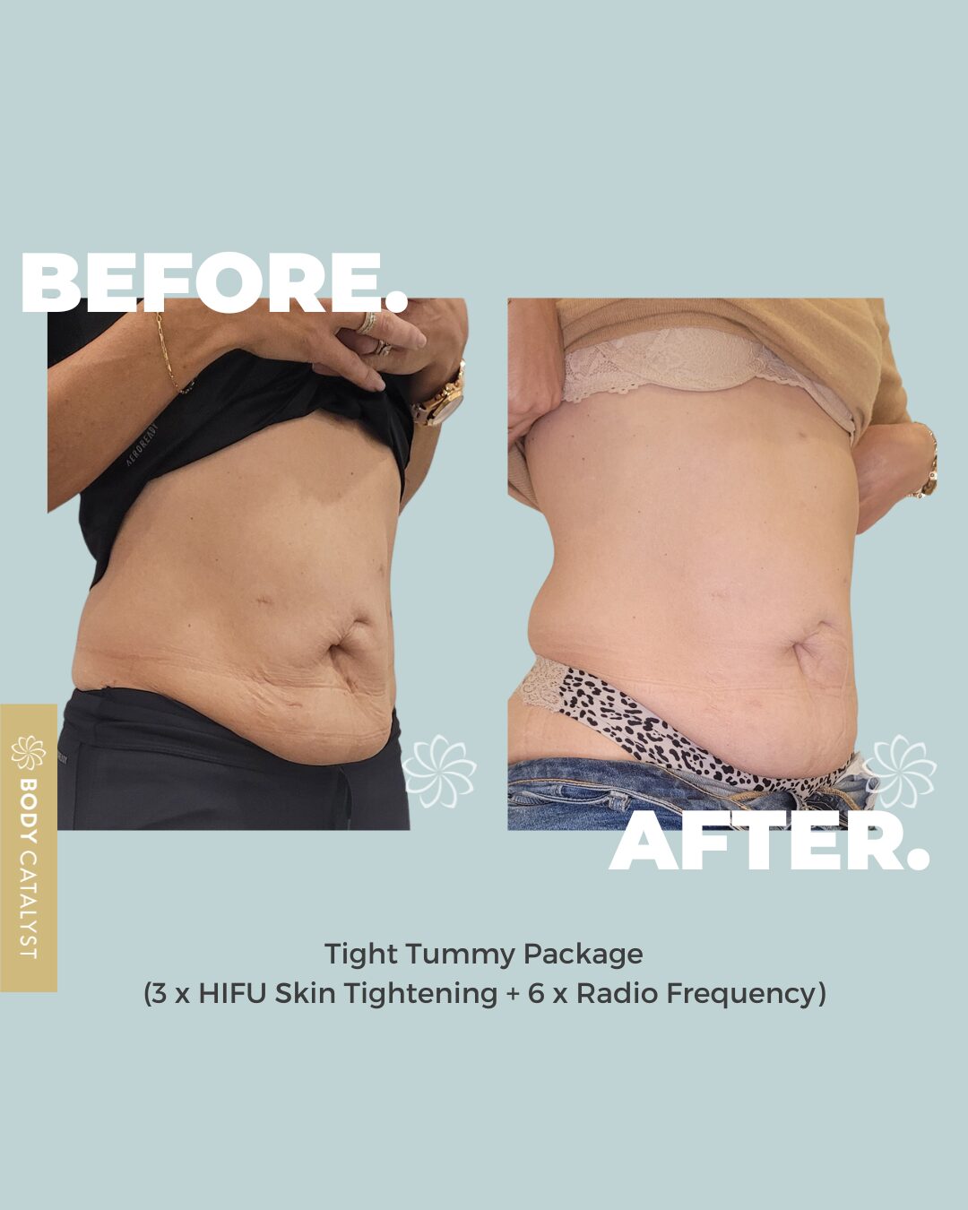 Tight Tummy Package - Image 3