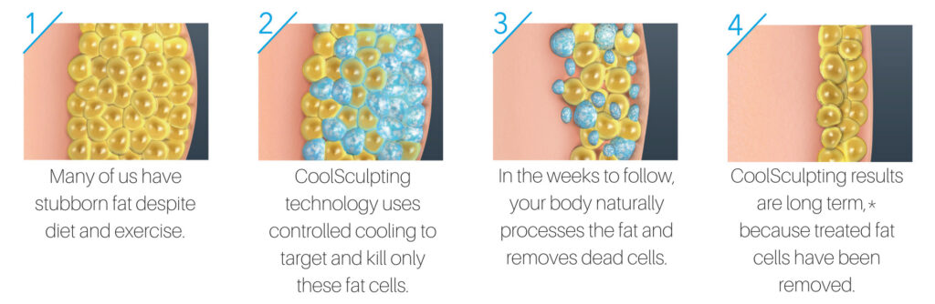 How Fat Freezing Works