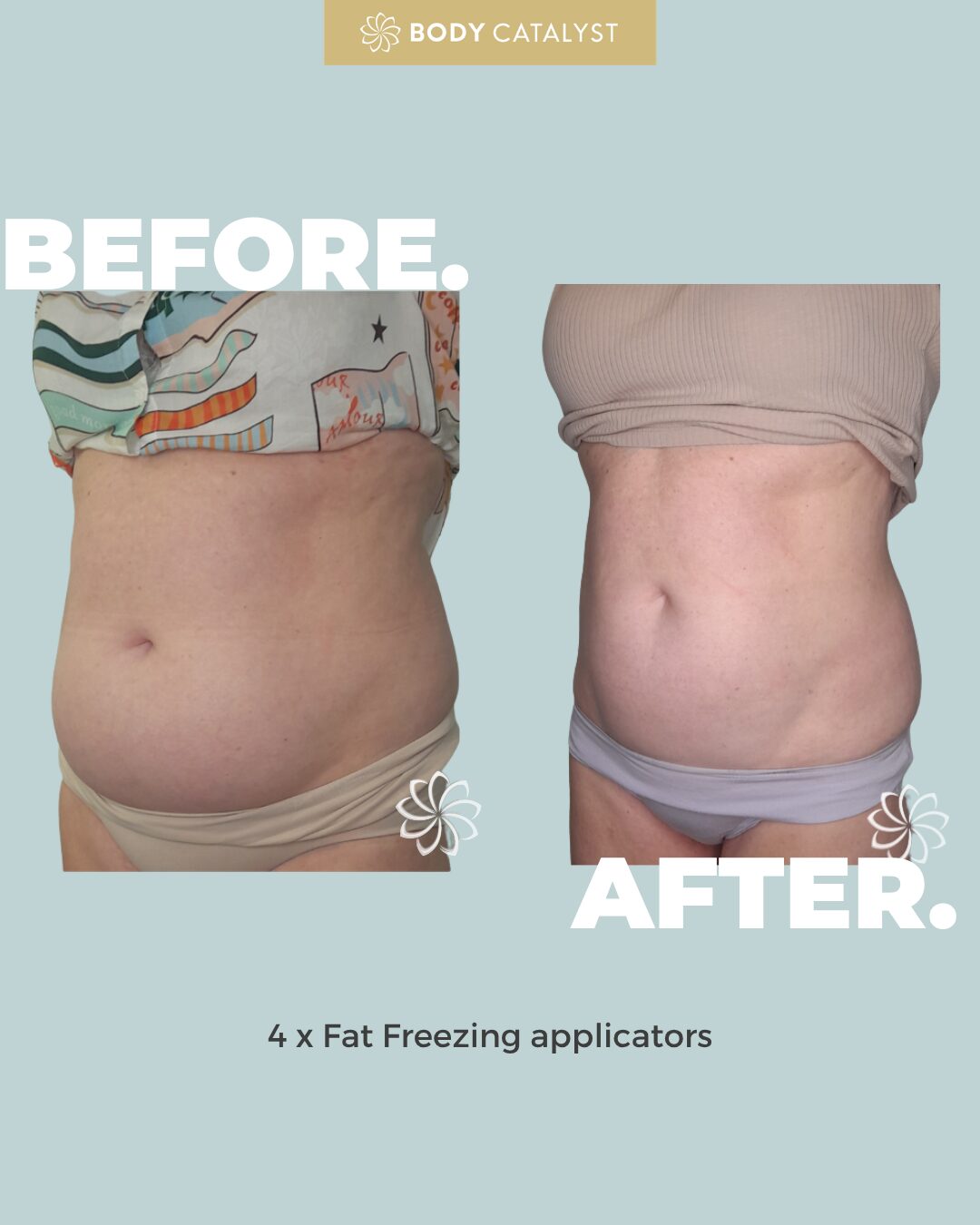 Fat Freezing (4 Applicators) - Image 6