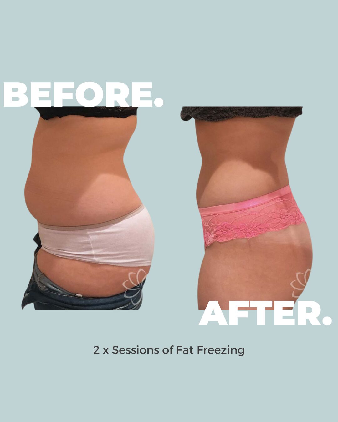 Fat Freezing (4 Applicators) - Image 5