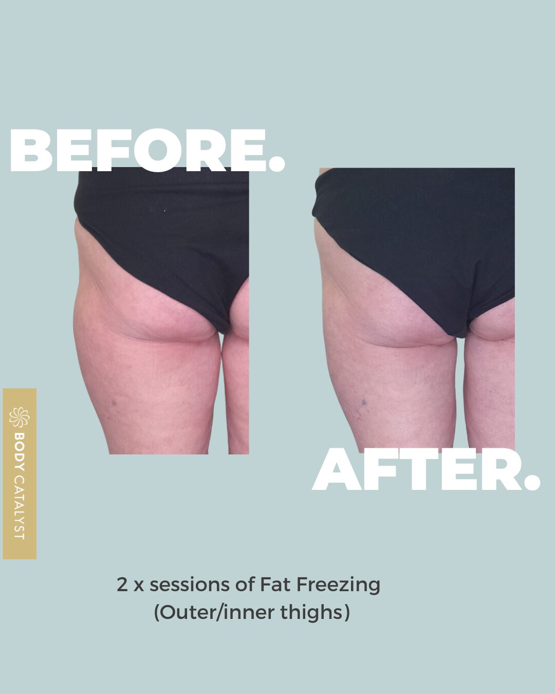 Fat Freezing (4 Applicators) - Image 7