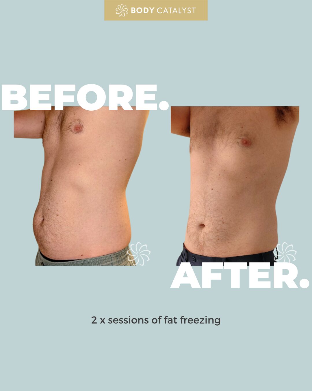 Fat Freezing (4 Applicators) - Image 3