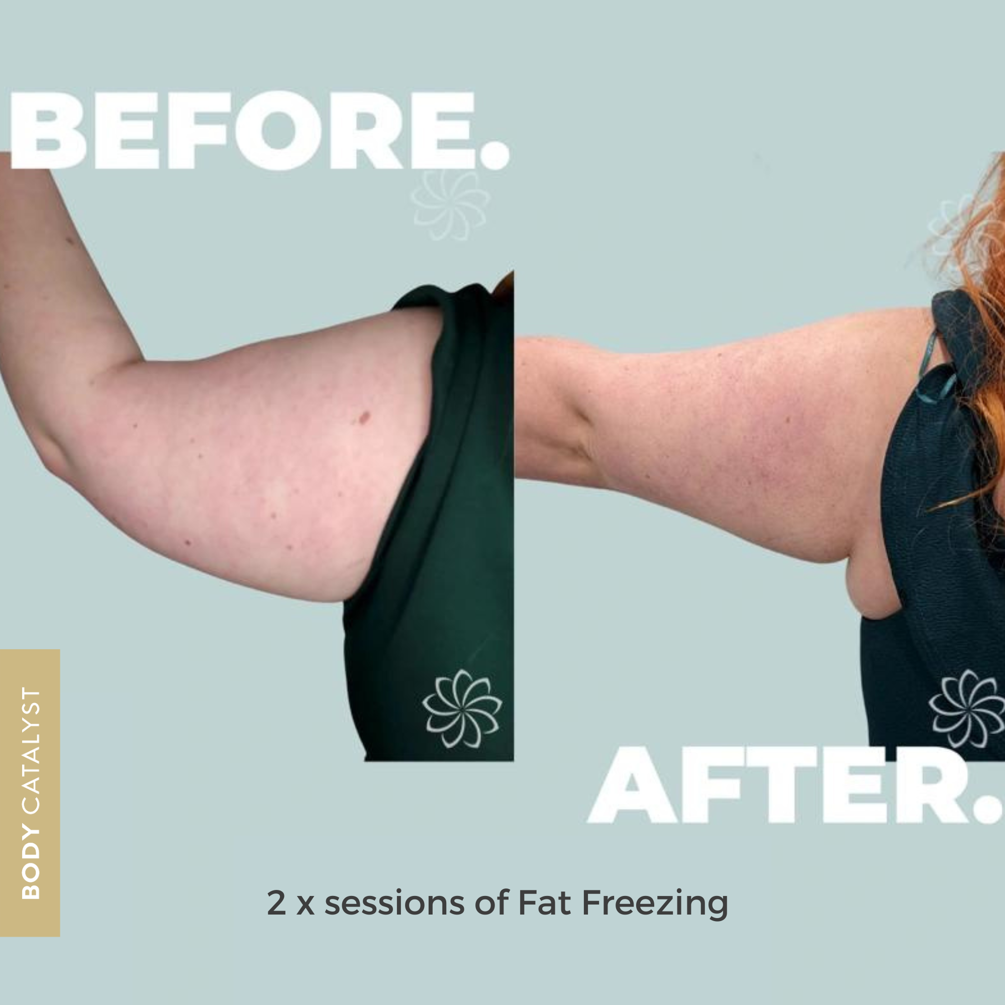 Menopause Weight Gain Treatment at Body Catalyst