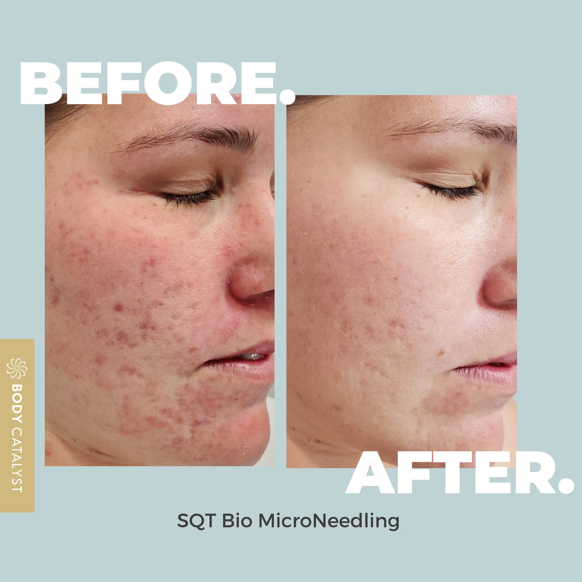 Rosacea Skin Care Treatments & SQT Bio-Microneedling | Body Catalyst