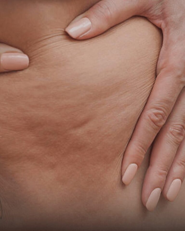 cellulite reduction treatment