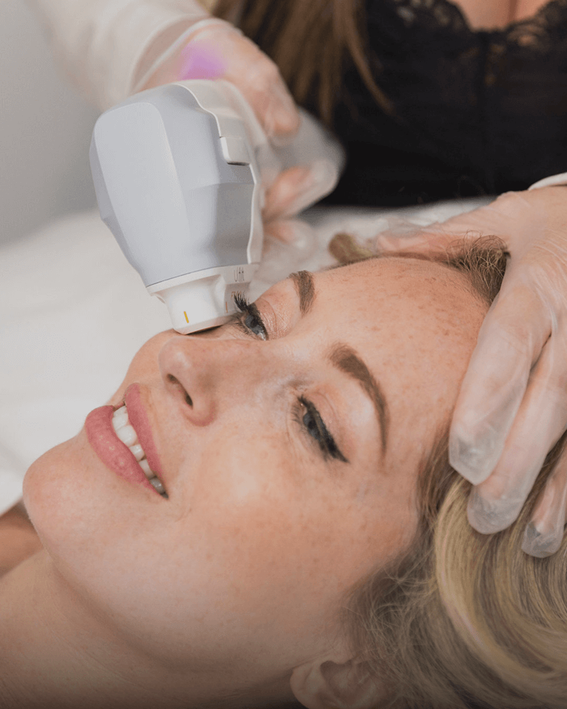 hifu non surgical facelift treatment