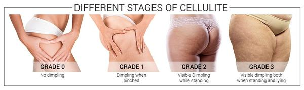 Cellulite Grading Chart
