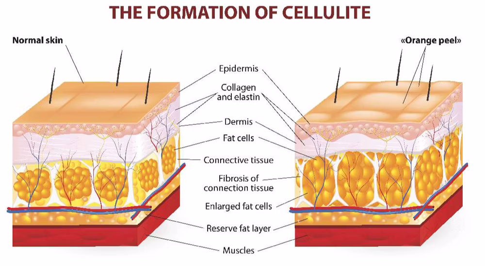 the formation of cellulite