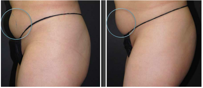 fat freezing clinical results