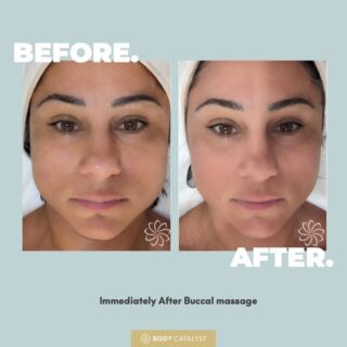 Instant results after our Buccal Massage ✨ The Buccal massage relieves jaw tension, improves circulation, and enhances the appearance of the face. ⁠
⁠
Our specially trained NOTOX therapists will conduct the buccal massage by focusing the massage around the Buccal area both inside and outside the mouth.  It can seem a little strange at first but the results are well worth it.⁠
⁠
✨ Relaxes the muscles in the Buccal area⁠
✨ Slims the face⁠
✨ The results are an immediate definition of the jaw area and a relaxed jaw that feels really wonderful.⁠
⁠
Click the link in bio to learn more! ⁠
⁠
#notox #notoxtransform #notoxskin #selfcare #skincare #beauty #healthyskin #antiageing #skin #glow #lift #wrinklereduction #bodycatalyst #skintransformation #hifu⁠ #buccalmassage
