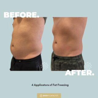 Chill out in the new year with 50% off your first fat freezing treatment! ❄️✨⁠
⁠
Experience up to 30% permanent fat reduction after your first session, and take it even further—up to 50% reduction with round two. But hey, let your tummy do the talking! Results speak louder than words. 🙌🔥⁠
⁠
Ready to freeze away 2023 and walk into the new year with confidence? ⁠
⁠
Click the link in bio to book your free consultation and redeem this offer now!