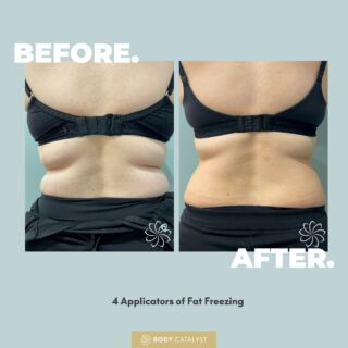 Sculpt a slimmer silhouette with Cryolipolysis fat freezing! ❄️⁠
⁠
Permanently eliminate up to 30% of fat cells in your first session, and up to 50% of fat cells by your second! 😍⁠
⁠
Want to know what 50% looks like, look no further than these sexy results!🧐😌⁠
⁠
Cryolipolysis Fat Freezing is the safe, easy and efficient non-surgical fat spot reduction procedure to give you the waistline of your wishes! ⁠
⁠
Not only is it non-surgical, but there’s no downtime! 😯⁠
⁠
Click the link in bio to buy now!⁠
⁠
#fatfreezing #cryo #bodyshaping #bodycatalyst #body #selflove #weightloss #loseweightfast #health #healthylifestyle #fatlossjourney #fatfreezingtreatment #fatfreezingsydney #lipo #fatfreezingmelbourne
