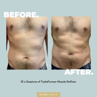 Worried a TeslaFormer workout won't be worth your while? Well, the results are in the 6-pack! 🤩⁠
⁠
Sculpt and define your muscles this summer with the TeslaFormer Muscle Definer, using Functional Magnetic Stimulation (FMS) technology to contract 100% of the muscle group for sculpted success! ⁠
⁠
Within a 30 minute session experience up to 50,000 muscle contractions, equivalent to training in the gym for about 4 hours non-stop!💪🏼⁠
⁠
Go the extra mile with a 45 minute sessions to achieve up to 72,000 contractions! 🙀⁠
⁠
Your summer body's waiting at your TeslaFormer appointment, click the link in bio to book now!