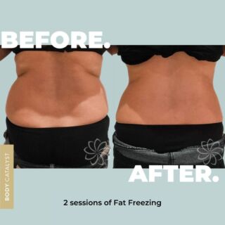 From frozen to fabulous😍 Witness the incredible transformation with these Cryolipolysis fat freezing results! ⁠
⁠
Here at Body Catalyst, we stand strongly by the motto ‘If you don't like it, Change it!’ And what better way to shift unwanted fat pockets than Fat Freezing! 💙🥶⁠
⁠
Fat freezing freezes fat cells down to -9 degrees, where the cells die and then are eliminated out of the body through the lymphatic system! ⁠
⁠
Once your body eliminates fat cells, you can never grow more, therefore it is a permanent fat reduction! No need for maintenance sessions! 🙌🏽🥳⁠
⁠
After 2 sessions see the incredible result of up to 50% fat reduction.⁠
⁠
Don’t like it? Change it! Click the link in bio to start now!⁠
⁠
#bodycatalyst #cryo #cryolipolysis #fatfreezing #fatreduction #weightloss #bodytransformation #fatloss #wellness #health #healthylifestyle #noninvasivelipo #bodypositive #selfcare #selflove #fatfreezingsydney