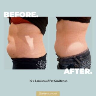 From flab to fab!!! Check out these incredible results from just 10 sessions! 😍⁠
⁠
Fat Cavitation is an incredible non-surgical fat reduction treatment to shrink the size of an overall area! If you’ve been looking at Liposuction but don't want the invasion and downtime associated, then cavitation is your best friend! 😇⁠
⁠
Cavitation uses ultrasound waves to shrink and shatter the fat cells, giving you a pain-free fat reduction treatment with natural results and no downtime! ⁠
⁠
The fat cells get drained through the lymphatic system and through exercise post treatment which is why we recommend pairing this baby with our TeslaFormer Muscle Definer!💪🏼⁠
⁠
Want these results? Click the link in bio to start now!⁠
⁠
#bodycatalyst #cavitation #fatcavitation #nonsurgicalliposuction #lipo #fatreduction #weightloss #weightlossjourney #bodytransofrmation