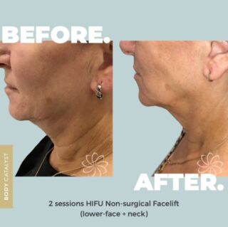 Turn back time without turning to the scalpel! 🕰️✨ ⁠
⁠
Our HIFU non-surgical facelifts are like a magic wand for aging gracefully. ⁠
Wave hello to tighter, lifted skin and goodbye to wrinkles. 👋🏼⁠
⁠
HIFU (high-intensity-focused-ultrasound) targets the lower, middle, and surface layers of the skin, stimulating collagen and elastin to non-surgically lift, contour and tighten your face! ⁠
⁠
Why should you book your first HIFU treatment?  Look at these ✨RESULTS✨!!⁠
⁠
It's your turn! Click the link to start!⁠
⁠
#bodycatalyst #hifu #nonsurgicalfacelift #hifufacelift #facelift #face #lift #nonsurgicallift #skin #selfcare #skincare #skinhealth #smilelines #jowls #doublechin #wrinkles #antiwrinkle #antiageing