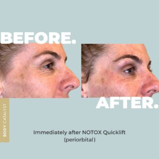 Erase lines not expressions with the NOTOX QuickLift! 🥰⁠
⁠
In just 30 minutes lift, contour and plump specific areas of the face and neck without surgery, needles or downtime. ✅⁠
⁠
Achieve ✨INSTANT✨ with HIFU (High-Intensity Focused Ultrasound) which continue to improve over time! These results speak for themselves!⁠
⁠
Are you ready for the best quickie of your life? ⁠
Click the link in bio to book now!⁠
⁠
#bodycatalyst #hifu #nonsurgicalfacelift #hifufacelift #facelift #notox #notoxquicklift #quicklift #lift #skin #selfcare #skincare #skinhealth #smilelines #jowls #doublechin #wrinkles #antiwrinkle #antiageing ⁠