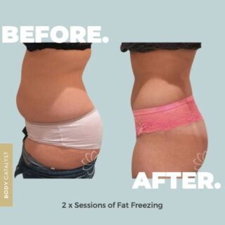 The frosty fix, you’ve been searching for — with hotter-than-ever results! ❄️🔥⁠
⁠
This dynamic duo has helped so many of our clients freeze off the stubborn fat for good, while strengthening, toning and defining their physique, so they look and feel hotter than ever!⁠
⁠
❄️Permanently eliminate up to 50% of stubborn fat cells in the treated area in only two sessions! ⁠
❄️Non-surgical, non-invasive & no downtime⁠
❄️Tone, define and strengthen you muscles with the TeslaFormer Muscle Definer ⁠
❄️Functional Magnetic Stimulation delivers up to 50,000 contractions in a 30 minute session — the equivalent of 50,000 crunches!⁠
⁠
From now until 8 April, we’ve frozen our prices on Fat Freezing, so you can freeze it off and tone it up for good! 🤩⁠
⁠
Click the link in bio to secure this sexy sale now!⁠