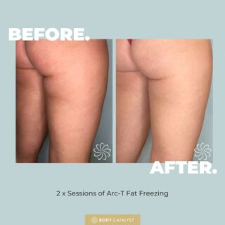It’s not everyday you see such a-peeling results! 🍌❄️ ⁠
⁠
From a bunch of banana rolls to a smooth and sexy silhouette — Fat Freezing is the frosty solution, that will leave you splitting with yours for good!⁠
⁠
BEFORE: Our lovely client was dealing with stubborn banana rolls — you know, those pesky layers under the buns that just refuse to split despite every attempt. 🚫⁠
⁠
AFTER: Fast Forward through a couple of chilly sessions et voilà! Our client’s behind is now as smooth as a peeled banana without any of that unwanted bunching! ⁠
⁠
For results like these, click the link in bio NOW and say bye-bye banana rolls 👋🏼⁠
⁠
#fatfreezing #cryo #bodyshaping #bodycatalyst #body #selflove #weightloss #loseweightfast #health #healthylifestyle #fatlossjourney #fatfreezingtreatment #fatfreezingsydney #lipo #fatfreezingmelbourne⁠
⁠