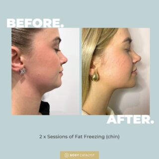Chin Chin! 🥂⁠
⁠
Results like these are worth celebrating, so grab a glass and pour yourself some bubbly … or better yet click the link in bio to sculpt and define your own chin!⁠
⁠
Fat Freezing permanently eliminates up to 50% of fat cells in just 2 sessions! We target that stubborn little pocket under your chin, that’s been so hard to shift, and it’s gone for good! ❄️⁠
⁠
Now you can look ✨snatched✨ from all angles!⁠
⁠
Cheers to that!⁠
⁠
#fatfreezing #cryo #bodyshaping #bodycatalyst #body #selflove #weightloss #loseweightfast #health #healthylifestyle #fatlossjourney #fatfreezingtreatment #fatfreezingsydney #lipo #fatfreezingmelbourne #doublechin #chinfat⁠