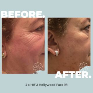 ⭐️Some Body Good Results! ⭐️⁠
⁠
Get A-list treatment with the HIFU Hollywood Non-surgical Facelift. ⁠
⁠
High-Intensity Focused Ultrasound stimulates collagen and elastin production, so you can feel body ageless! ⁠
⁠
Our 1.5mm depth cartridge smoothes fine lines and wrinkles without surgery, needles or downtime! ⁠
⁠
Experience instant result which continue to improve over 4 weeks!⁠
⁠
💫Go on you all-star book your Hollywood glow-up NOW for just $549 (originally $670)!💫⁠
⁠
Click the link to shop now!⁠
⁠
#bodycatalyst #mybodycatalyst #feelbodygood #feelbodygoodsale #hifu #hifuhollywood #hifufacelift #facelift #hollywoodfacelift #nonsurgicalfacelift #lift #contour #skintightening #hifusale #skincare #skin #selflove #selfcare #facetreatment