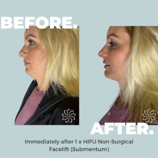 Immediate results that speak volumes📣😍⁠
⁠
Transform your beauty journey instantly with our HIFU Non-Surgical Facelift! ⁠
⁠
Using high intensity focused ultrasound technology to stimulate collagen and elastin production in as deep as the SMAS (muscle) layer for insane results!! ⁠
⁠
You think these instant results are good? Well wait till you find out that they get better over the next 12 weeks!! 😝⁠
⁠
Keep the good news coming.... this treatment's on sale now!! 🙈⁠
⁠
Click the link in bio to start! ⁠
⁠
#bodycatalyst #mybodycatalyst #feelbodygood #feelbodygoodsale #hifu #hifuhollywood #hifufacelift #facelift #hollywoodfacelift #nonsurgicalfacelift #lift #contour #skintightening #hifusale #skincare #skin #selflove #selfcare #facetreatment