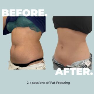 Results so 'body' good you'll think it's a new person!!⁠
⁠We’re all about loving the skin you're in, so why not love it a little more? 🩵⁠
⁠
Permanently eliminate up to 50% of stubborn fat cells in 2 sessions with Fat Freezing!⁠❄️⁠
⁠
Fat Freezing lowers the treatment area to -9°. Fortunately for you, fat cells cannot survive at this temperature, so they crystallise, die and over a period of 12 weeks are naturally eliminated from the body. ⁠
⁠
And best of all, you can have these results with no downtime whatsoever!😱⁠
⁠
Feel body good with Fat Freezing! ⁠
ON SALE NOW! Click the link in bio!⁠
⁠
#bodycatalyst #feelbodygood #feelbodygoodsale #mybodycatalyst #fatfreezing #fatfreezingsale #fatfreezingsydney #fatfreezingmelbourne #fatfreezingnz #cryo #cryolipolysis #coolsculpting #bodytransformation #fatreduction #fatloss #weightloss #bodypositive #bodysculpting #bodytreatments #beauty