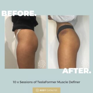 Booty-ful Results!🍑😍⁠
⁠
Ready to pump up those peachy cheeks!? The TeslaFormer Muscle Definer does a 'body' good job! ⁠🙌🏽⁠
⁠
With results like these you’ll want to stop hitting the gym immediately and run as fast as you can to your nearest Body Catalyst! 🏃🏼‍♀️⁠💨⁠
⁠
The TeslaFormer Muscle Definer is ON SALE NOW for just $139/session (*pre-pay 5 or 10 sessions)!⁠
⁠
Click the link in bio to get started!⁠
⁠
#bodycatalyst #mybodycatalyst #teslaformer #teslaformermuscledefiner #muscledefiner #muscledefinition #FMS #FMStechnology #emsculpt #muscles #muscletoning #bodytransformation #weightloss #fatloss #bodygoals #bodypositive #bodysculpting #gym #gymjunkie #workout ⁠
#glutegrowth #gluteworkout